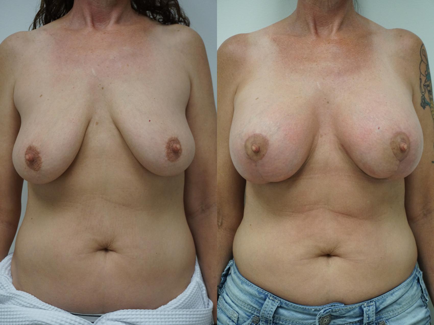 Before & After Breast Augmentation with Breast Lift  Case 100 View #1 View in Gilbert, AZ