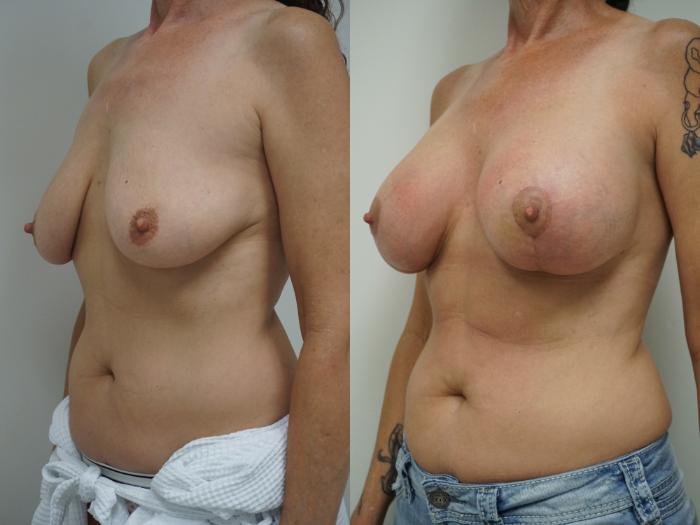 Before & After Breast Lift with Implants Case 100 View #2 View in Gilbert, AZ
