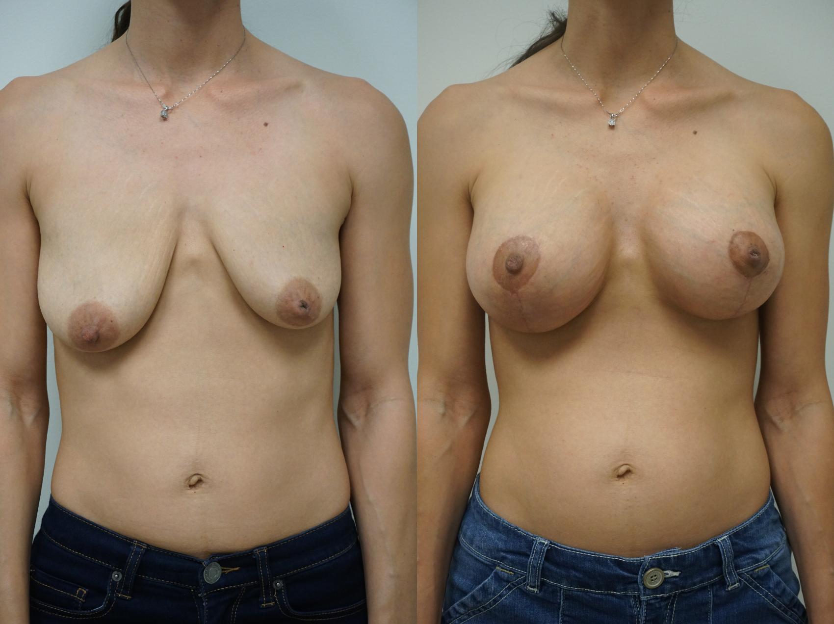 Before & After Breast Augmentation with Breast Lift  Case 109 View #1 View in Gilbert, AZ