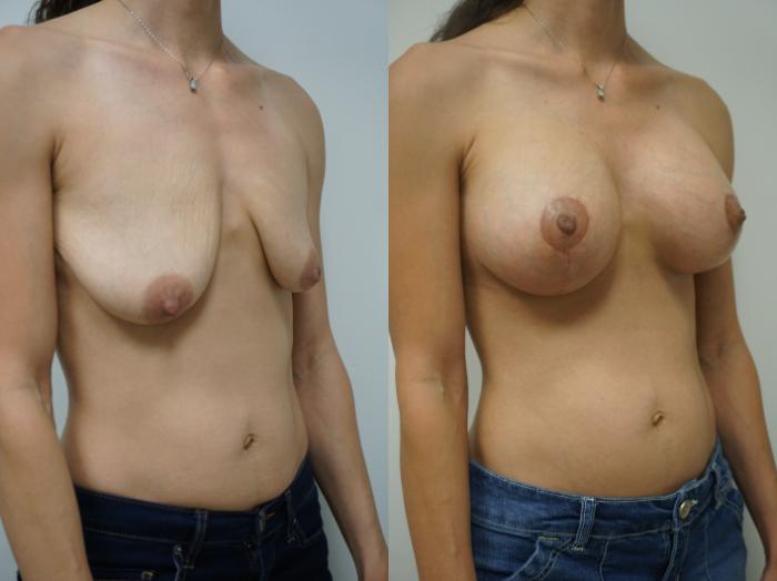 Before & After Breast Augmentation with Breast Lift  Case 109 View #2 View in Gilbert, AZ