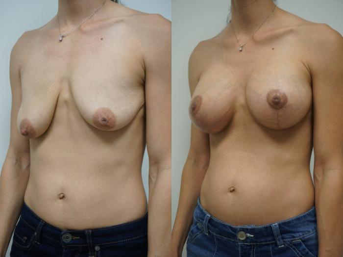 Before & After Breast Augmentation with Breast Lift  Case 109 View #3 View in Gilbert, AZ