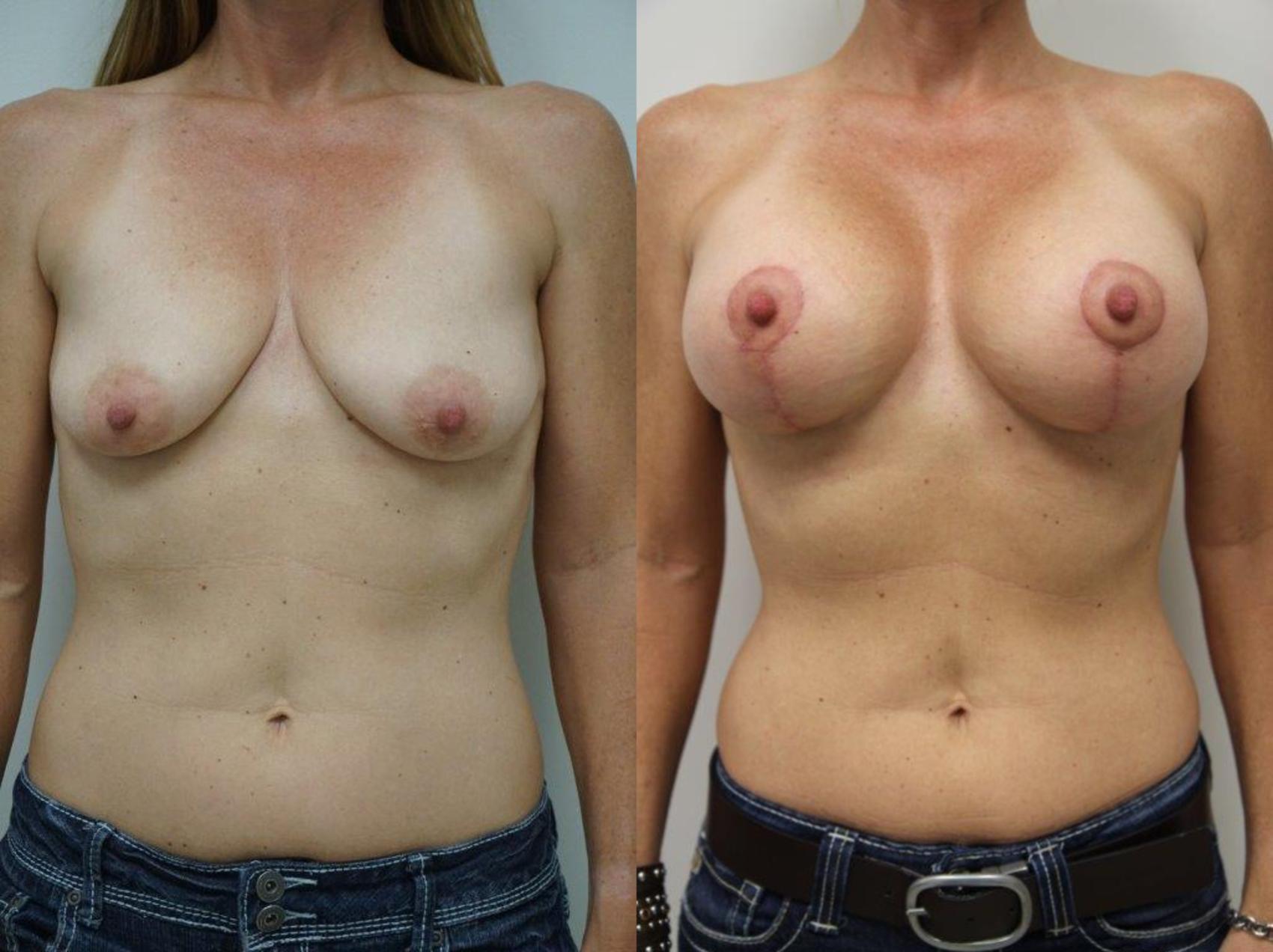 Before & After Breast Augmentation with Breast Lift  Case 125 View #1 View in Gilbert, AZ