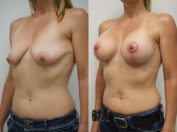 Before & After Breast Augmentation with Breast Lift  Case 125 View #2 View in Gilbert, AZ