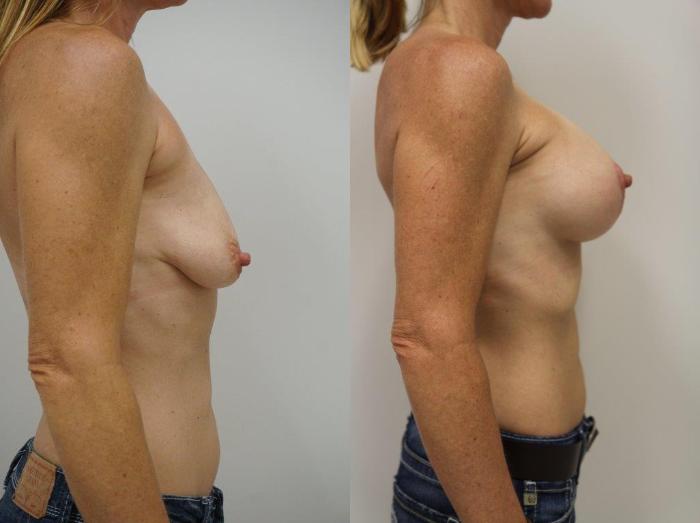Before & After Breast Augmentation with Breast Lift  Case 125 View #3 View in Gilbert, AZ