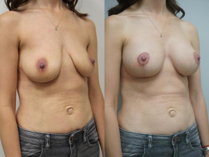 Before & After Breast Augmentation with Breast Lift  Case 133 View #2 View in Gilbert, AZ