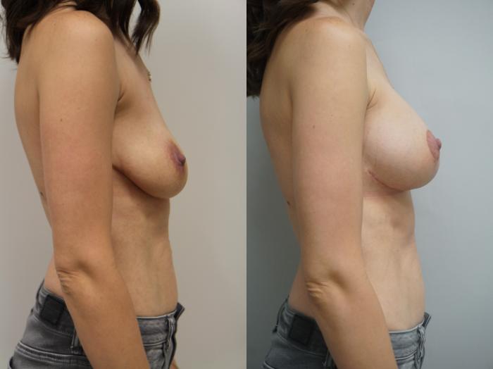 Before & After Breast Augmentation with Breast Lift  Case 133 View #3 View in Gilbert, AZ