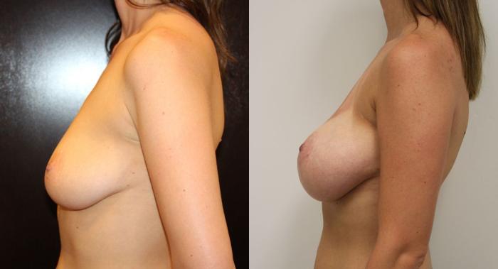 Before & After Breast Augmentation with Breast Lift  Case 16 View #4 View in Gilbert, AZ