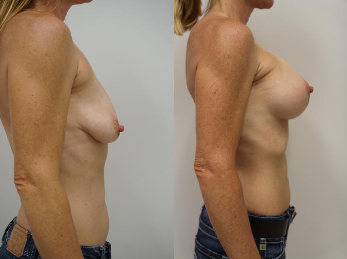 Before & After Breast Augmentation with Breast Lift  Case 164 View #3 View in Gilbert, AZ