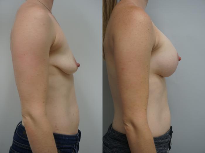 Before & After Breast Lift with Implants Case 172 View #1 View in Gilbert, AZ
