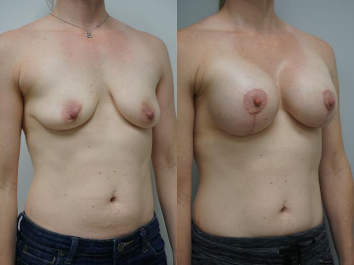 Before & After Breast Augmentation with Breast Lift  Case 172 View #2 View in Gilbert, AZ