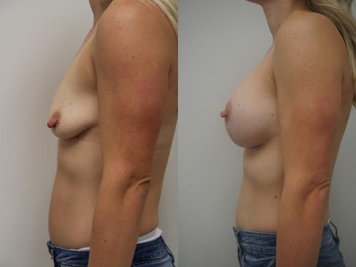 Before & After Breast Lift with Implants Case 205 View #1 View in Gilbert, AZ
