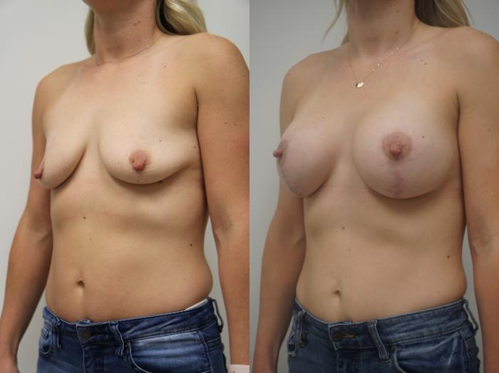 Before & After Breast Augmentation with Breast Lift  Case 205 View #2 View in Gilbert, AZ