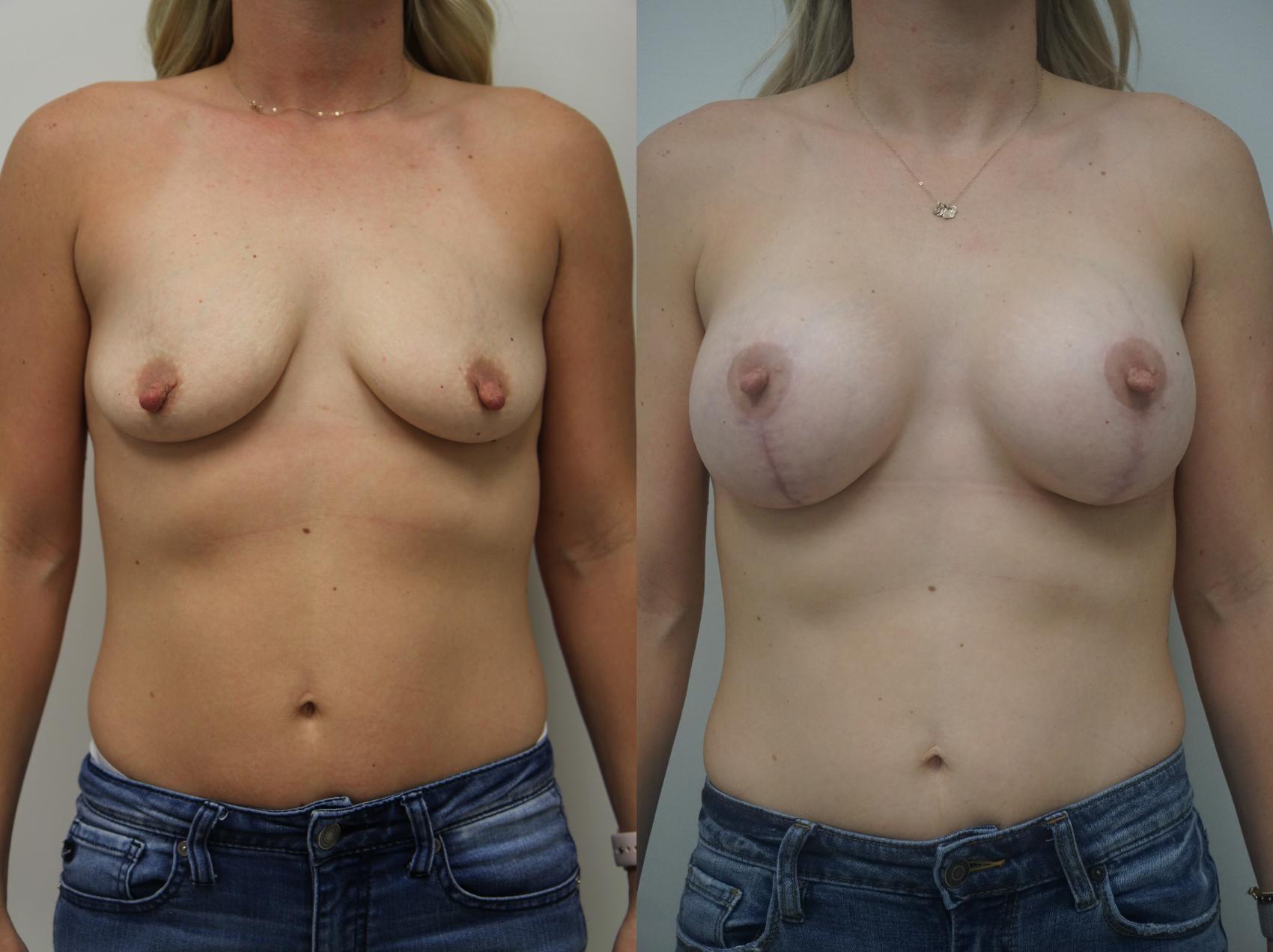 Before & After Breast Augmentation with Breast Lift  Case 205 View #3 View in Gilbert, AZ