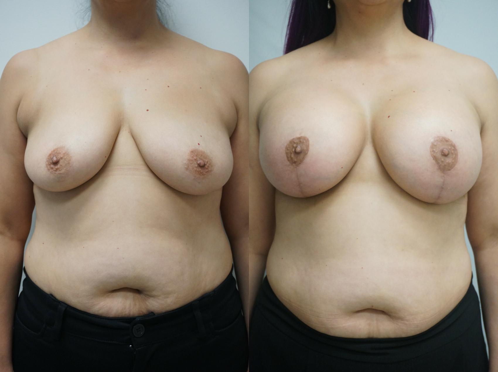 Before & After Breast Lift (No Implant) Case 236 View #1 View in Gilbert, AZ