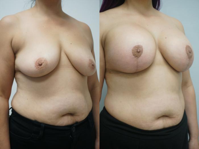 Before & After Breast Augmentation with Breast Lift  Case 236 View #2 View in Gilbert, AZ