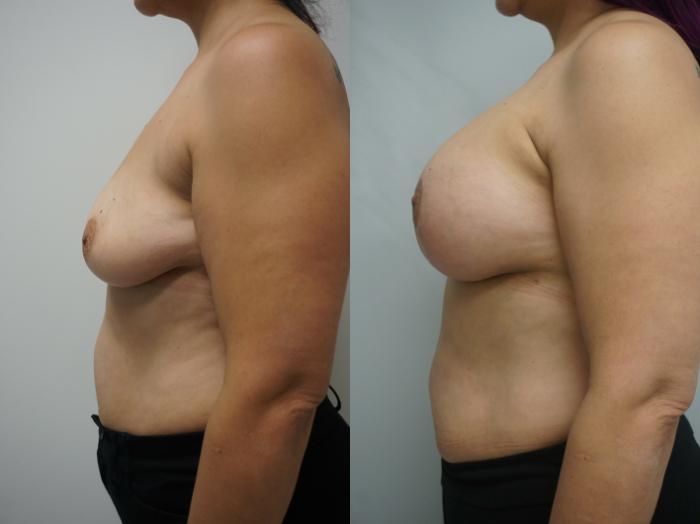 Before & After Breast Augmentation with Breast Lift  Case 236 View #3 View in Gilbert, AZ