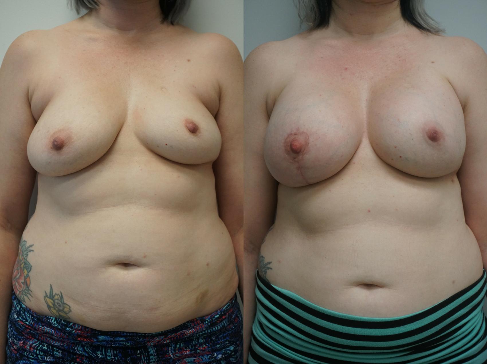 Before & After Breast Augmentation with Breast Lift  Case 242 View #1 View in Gilbert, AZ