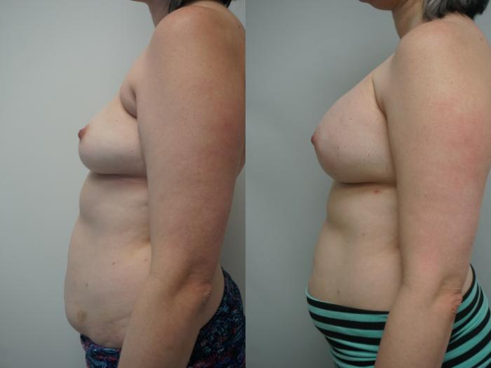 Before & After Breast Augmentation with Breast Lift  Case 242 View #2 View in Gilbert, AZ