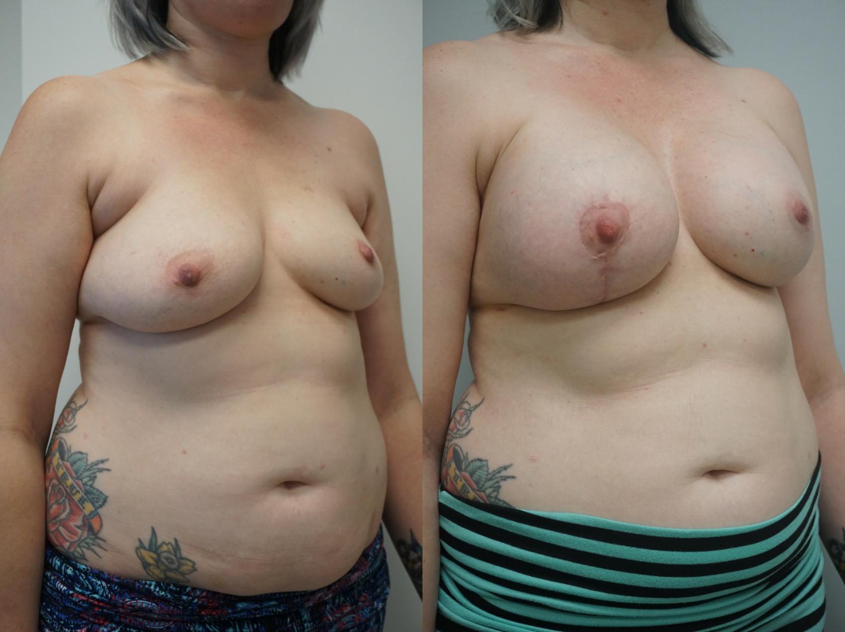 Before & After Breast Augmentation with Breast Lift  Case 242 View #3 View in Gilbert, AZ