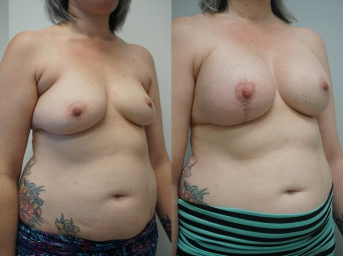 Before & After Breast Augmentation with Breast Lift  Case 242 View #3 View in Gilbert, AZ