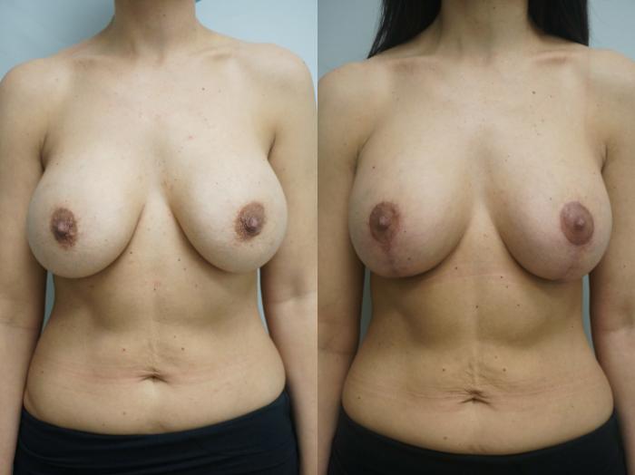 Before & After Breast Augmentation with Breast Lift  Case 245 View #2 View in Gilbert, AZ