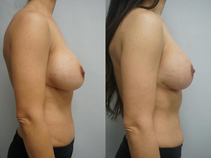 Before & After Breast Augmentation with Breast Lift  Case 245 View #3 View in Gilbert, AZ