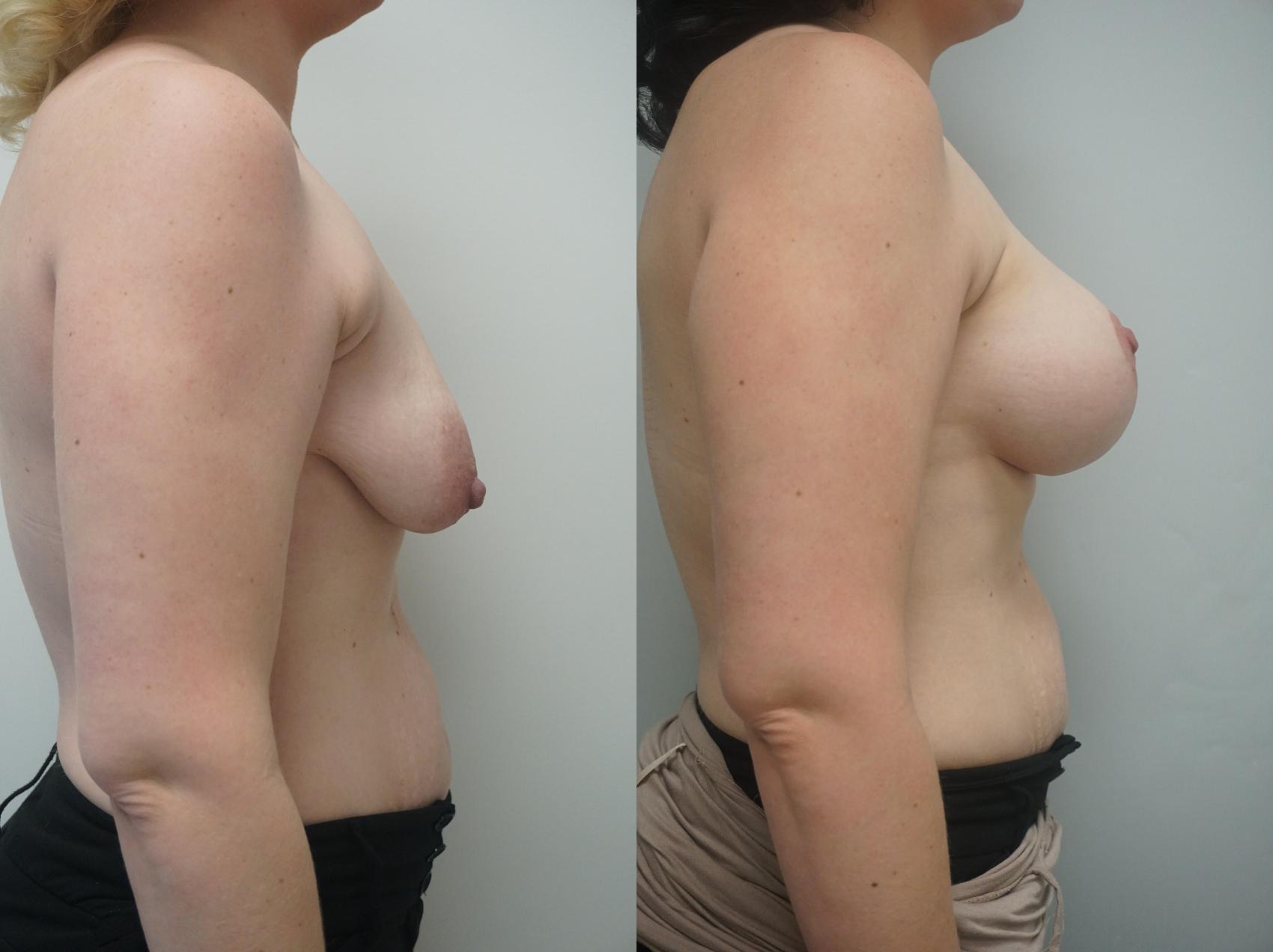 Before & After Breast Augmentation with Breast Lift  Case 253 View #1 View in Gilbert, AZ