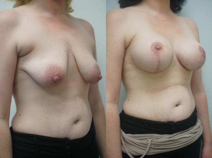 Before & After Breast Augmentation with Breast Lift  Case 253 View #2 View in Gilbert, AZ