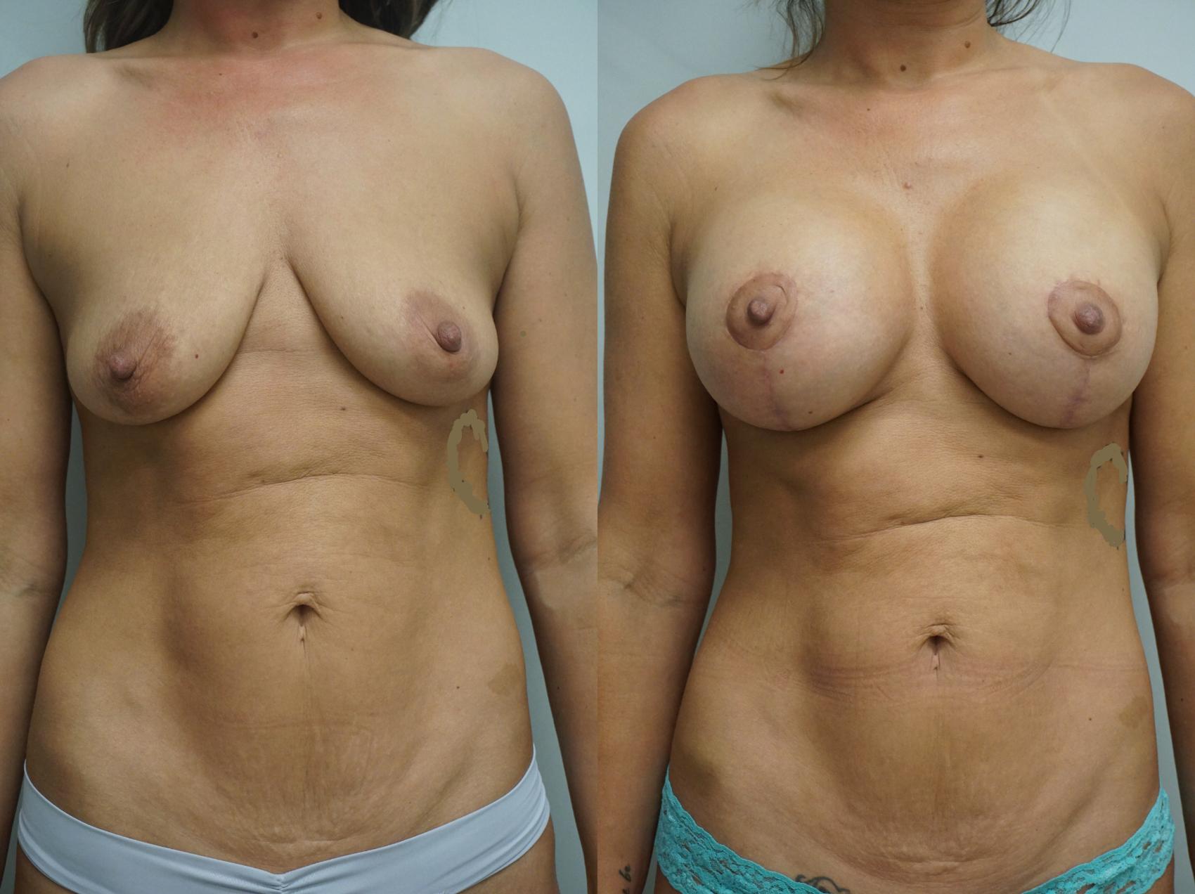 Before & After Breast Augmentation with Breast Lift  Case 267 View #1 View in Gilbert, AZ