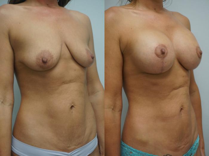 Before & After Breast Augmentation with Breast Lift  Case 267 View #2 View in Gilbert, AZ