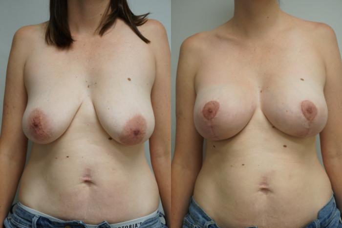 Before & After Breast Lift with Implants Case 284 Front View in Gilbert, AZ