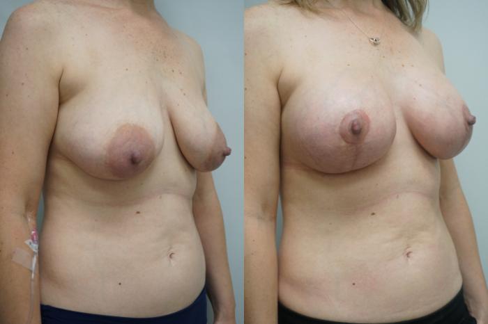 Before & After Breast Augmentation with Breast Lift  Case 285 Right Oblique View in Gilbert, AZ