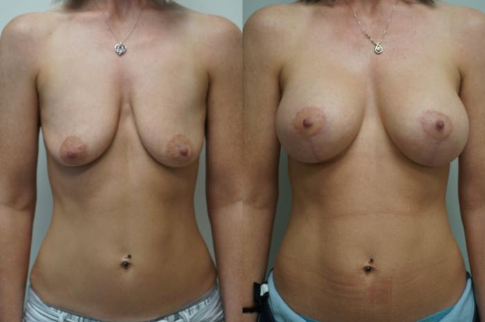 Before & After Breast Lift with Implants Case 289 Front View in Gilbert, AZ