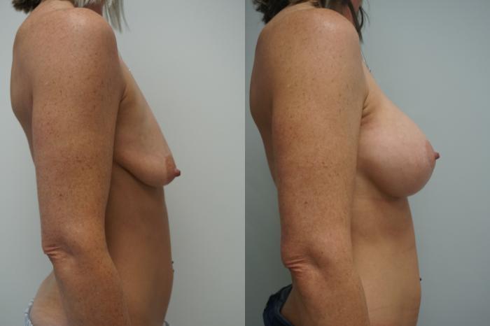 Before & After Breast Lift with Implants Case 289 Right Side View in Gilbert, AZ