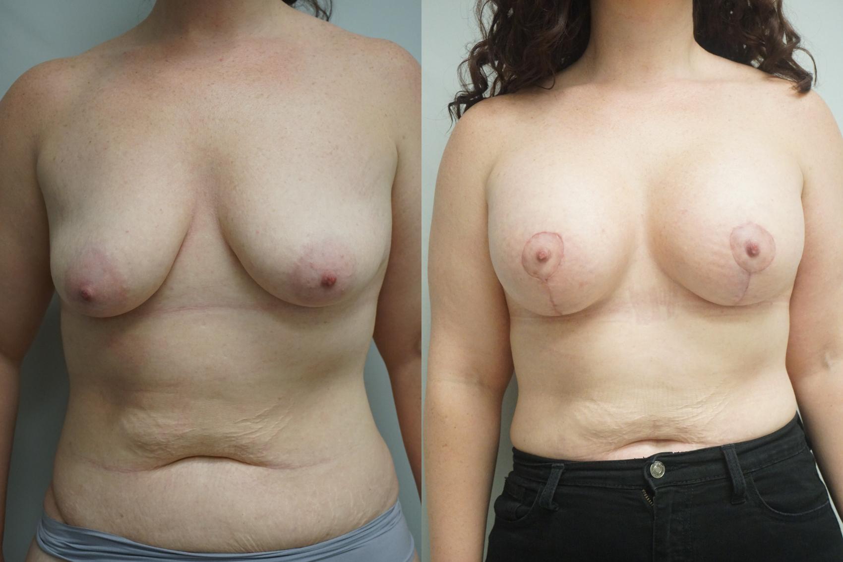 Before & After Breast Augmentation Case 291 Front View in Gilbert, AZ