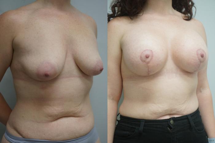 Before & After Breast Augmentation Case 291 Right Oblique View in Gilbert, AZ