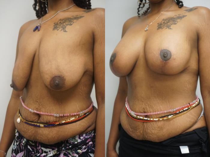 Before & After Breast Augmentation Case 308 Left Oblique View in Gilbert, AZ