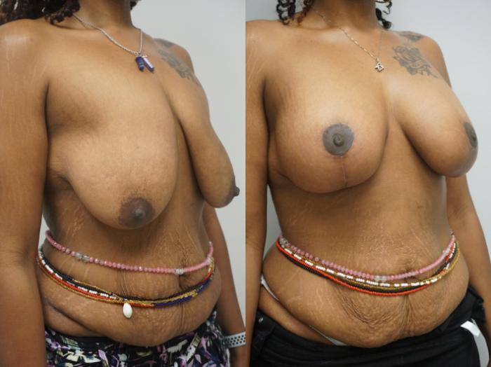 Before & After Breast Augmentation with Breast Lift  Case 308 Right Oblique View in Gilbert, AZ
