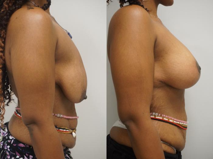 Before & After Breast Augmentation Case 308 Right Side View in Gilbert, AZ