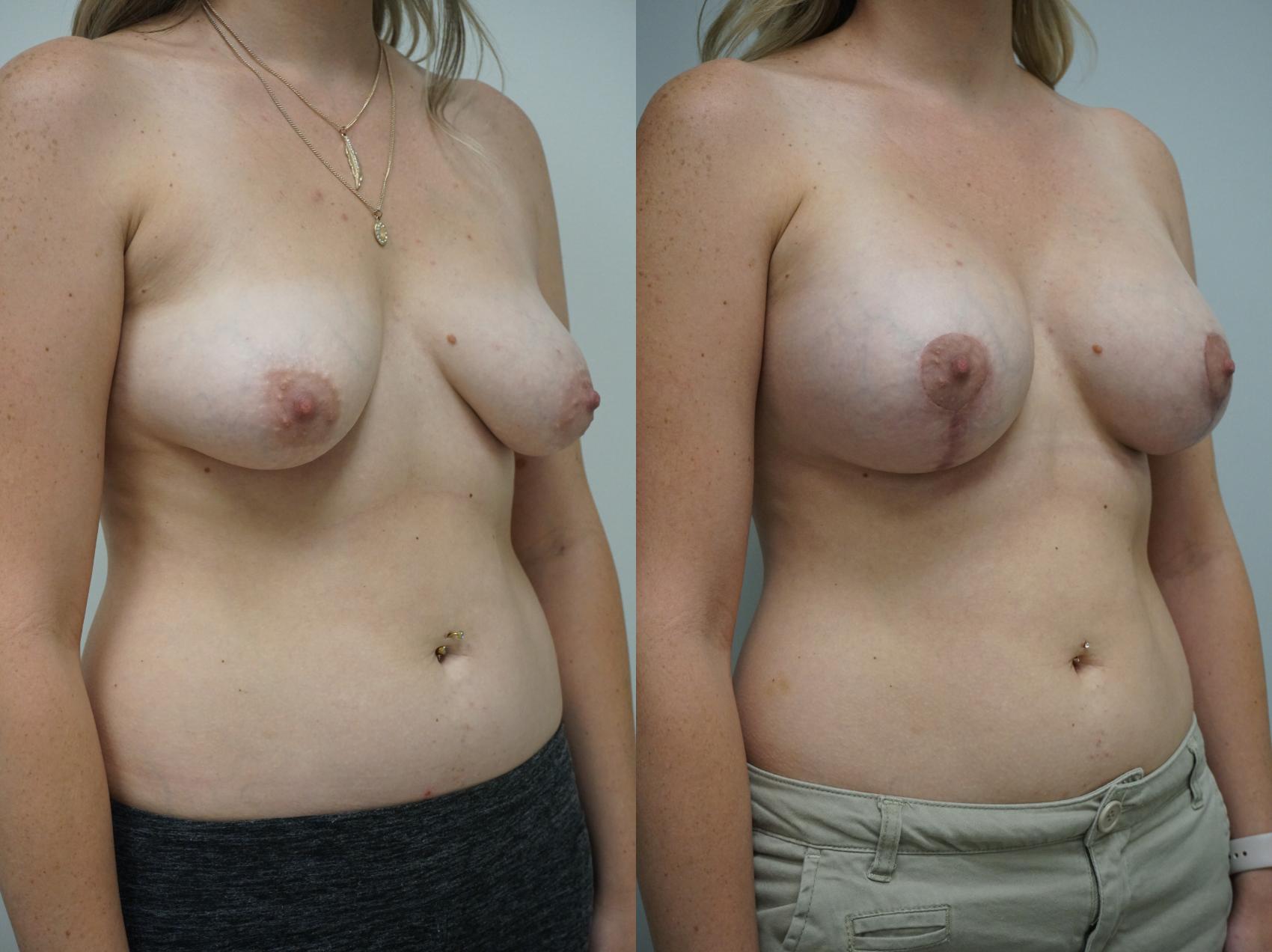 Before & After Breast Augmentation with Breast Lift  Case 310 Front View in Gilbert, AZ