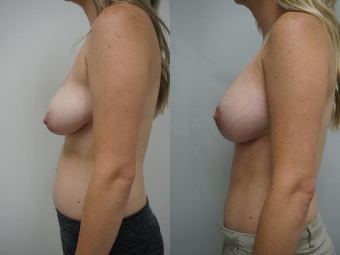 Before & After Breast Augmentation with Breast Lift  Case 310 Left Side View in Gilbert, AZ