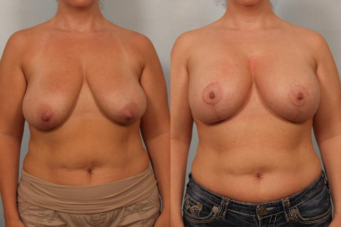 Before & After Breast Augmentation with Breast Lift  Case 62 View #1 View in Gilbert, AZ