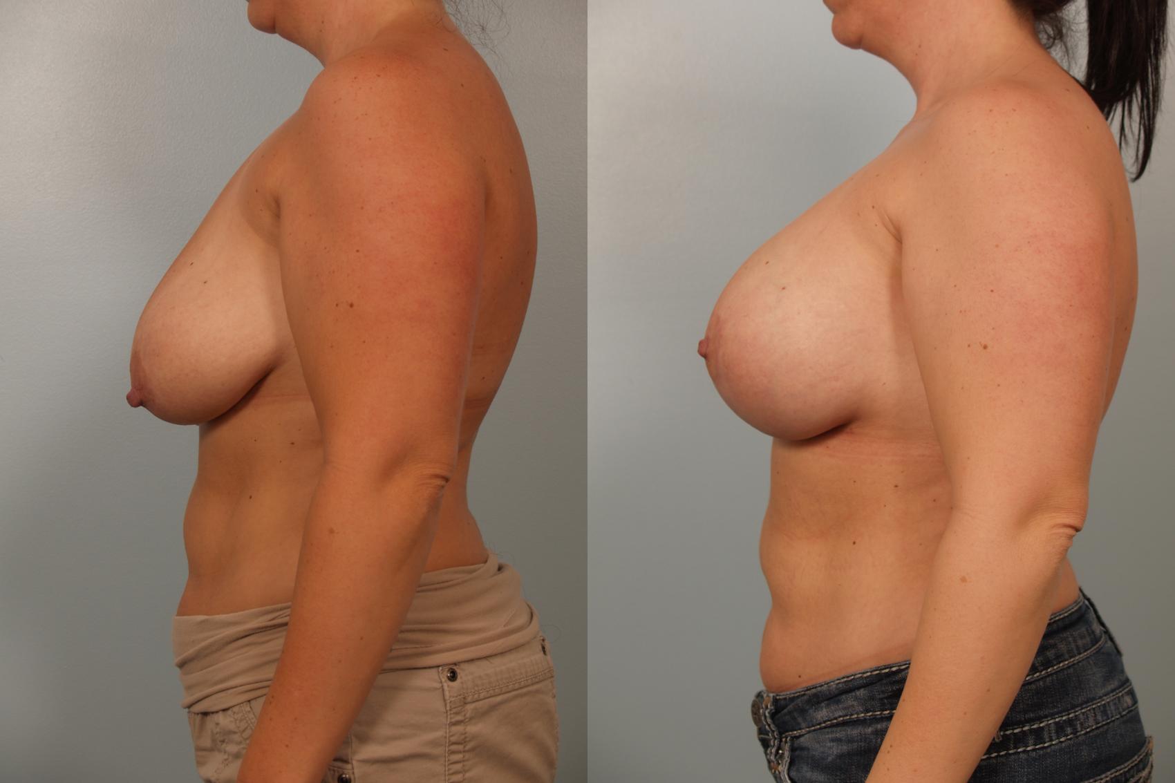 Before & After Breast Augmentation with Breast Lift  Case 62 View #2 View in Gilbert, AZ