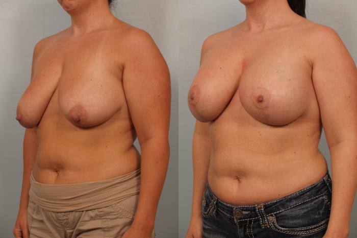 Before & After Breast Augmentation with Breast Lift  Case 62 View #3 View in Gilbert, AZ