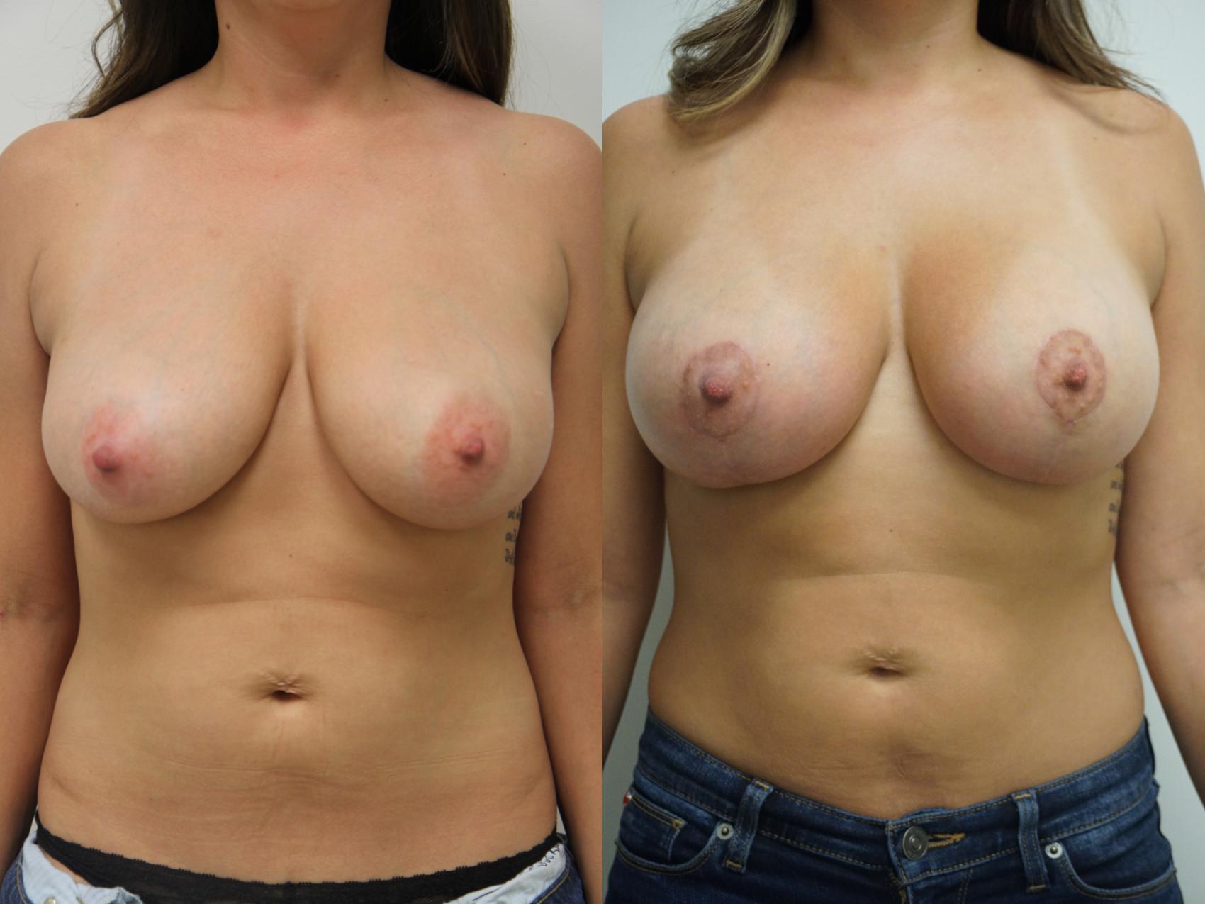Before & After Breast Augmentation with Breast Lift  Case 77 View #1 View in Gilbert, AZ