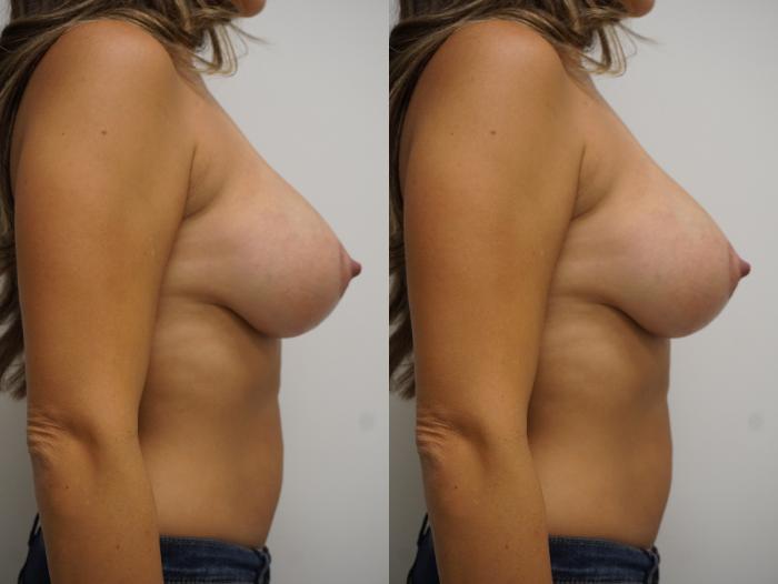 Before & After Breast Augmentation with Breast Lift  Case 77 View #3 View in Gilbert, AZ