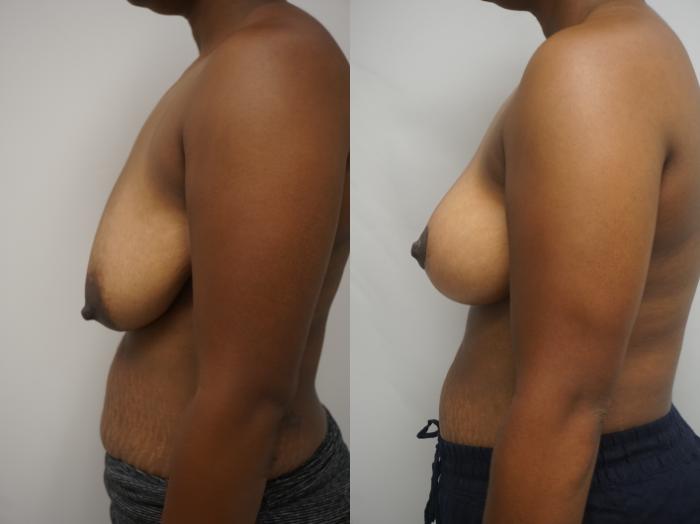 Before & After Breast Lift (No Implants) Case 194 View #1 View in Gilbert, AZ
