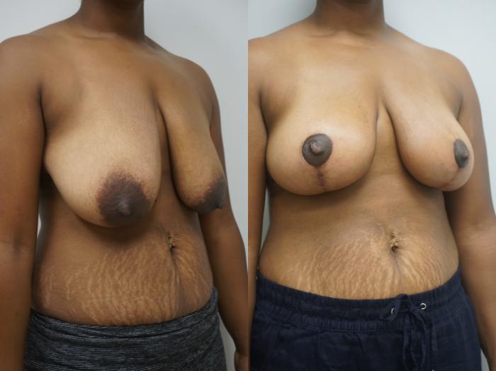 Before & After Breast Lift (No Implants) Case 194 View #2 View in Gilbert, AZ
