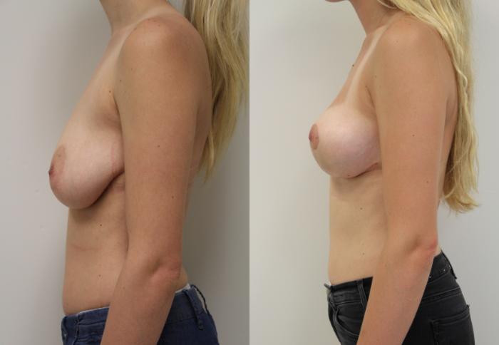 Before & After Breast Lift (No Implants) Case 33 View #2 View in Gilbert, AZ