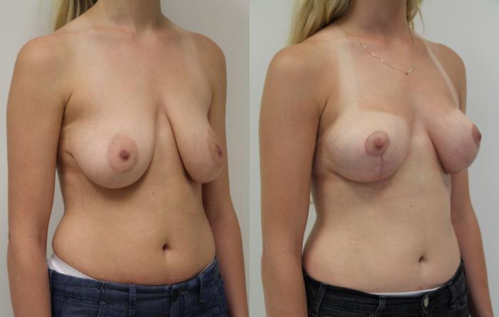 Before & After Breast Lift (No Implants) Case 33 View #3 View in Gilbert, AZ